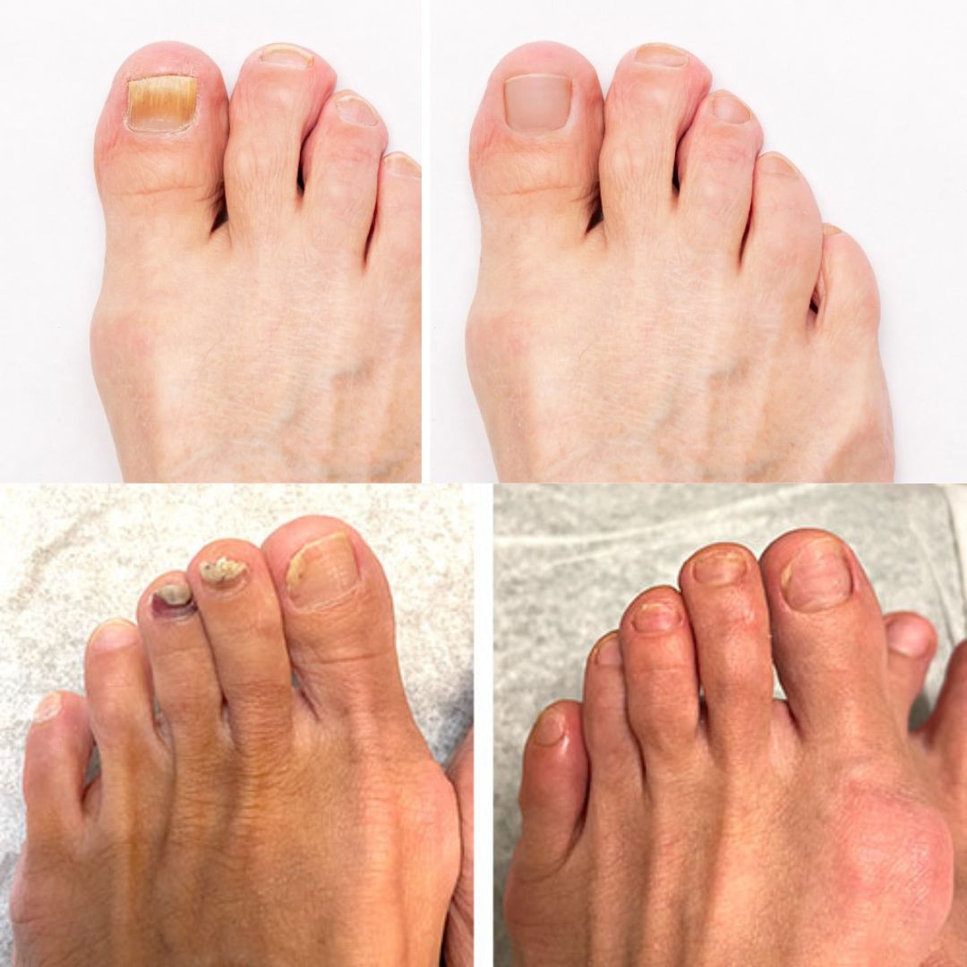 PureNail - patentierte Nagelpilz-Therapie - für gesunde Nägel innerhalb von 4 Wochen