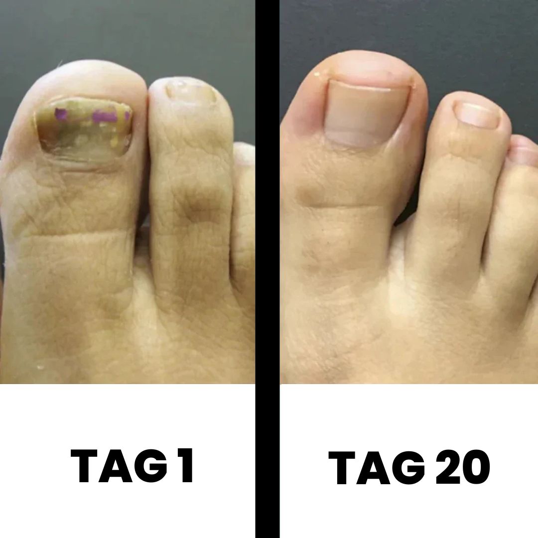 DermaNail - patentierte Nagelpilz-Therapie - für gesunde Nägel innerhalb von 4 Wochen
