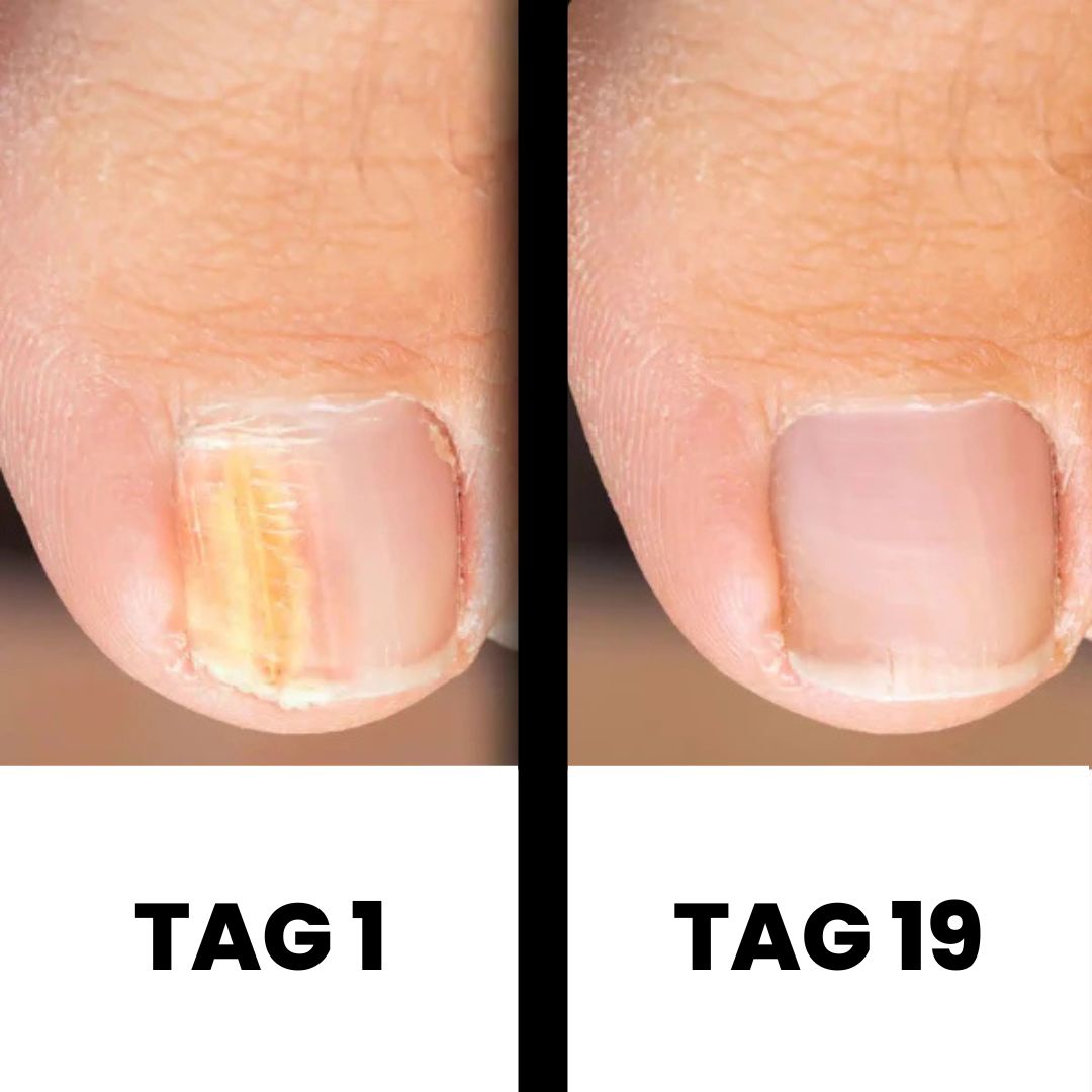 PureNail - patentierte Nagelpilz-Therapie - für gesunde Nägel innerhalb von 4 Wochen