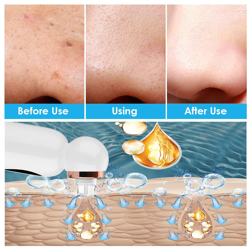 Loopstep | Hydrodermabrasion Mitesserentferner