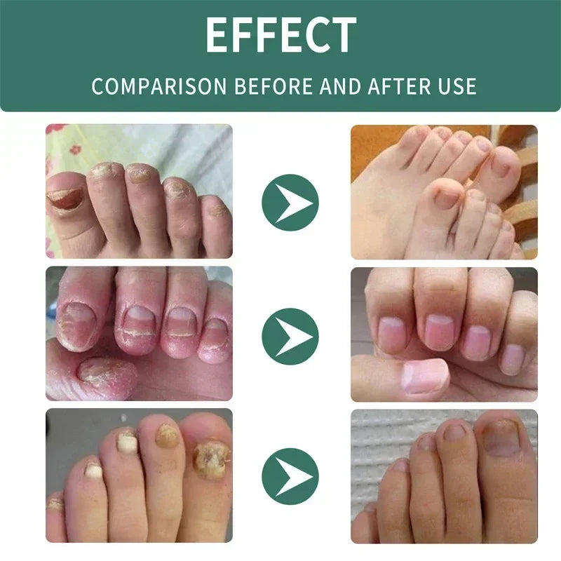 Loopstep | Nagelpilz Verteidiger Serum